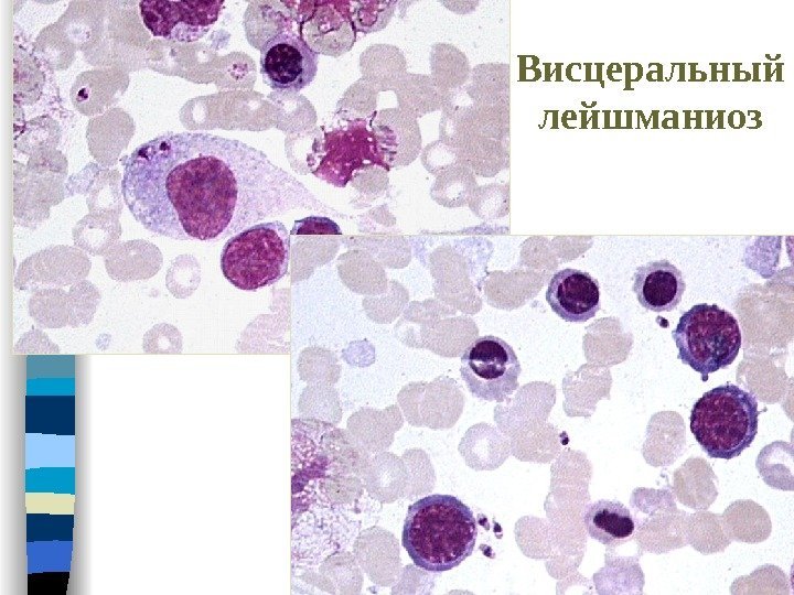 Особенность картины периферической крови при висцеральной форме лейшманиоза